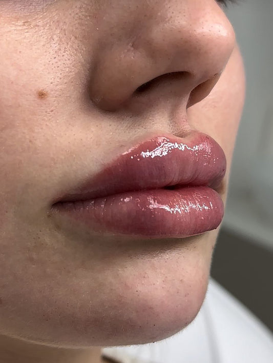 Botox (Toxina Botulínica)